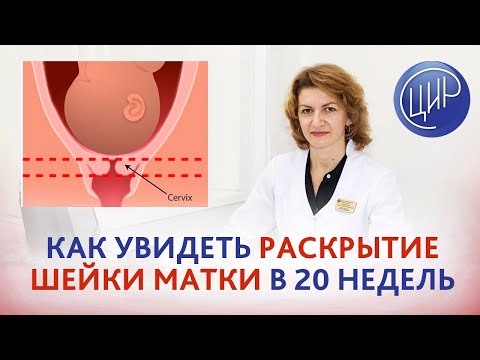 Цервикометрия в 20 недель. Можно ли увидеть раскрытие шейки матки на цервикометрии в 20 недель?