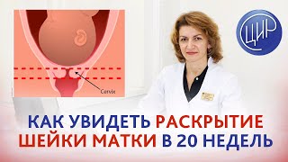 Цервикометрия в 20 недель. Можно ли увидеть раскрытие шейки матки на цервикометрии в 20 недель?