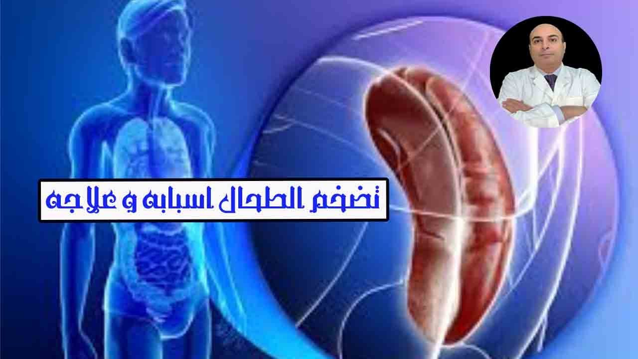اسباب تضخم الطحال و علاجه