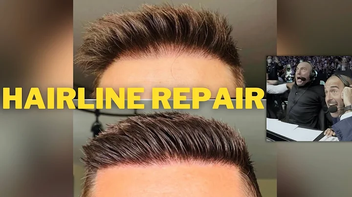 INCREDIBLE!! Hair Transplant Repair By Dr. Jerry C...