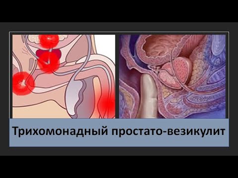 Трихомонадный простато-везикулит