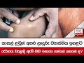 පාසල් ළමුන් අතර ලාදුරු ව්‍යාප්තිය ඉහළට... රෝගය වැලඳී ඇති බව සොයා ගන්නේ කෙසේ ද?