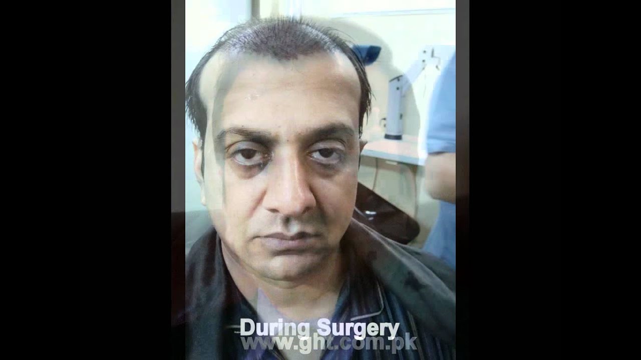 Hair Transplant Videos In Pakistanpakistan Hair Transplant Videos