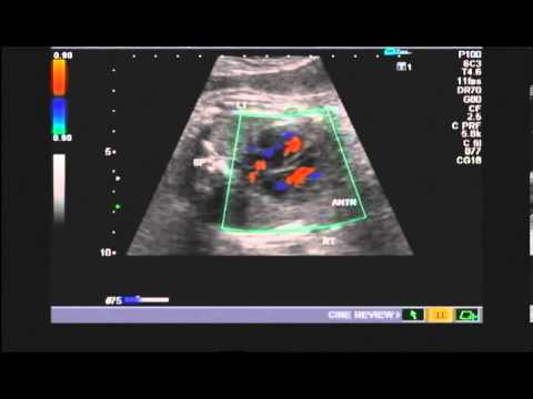 fetal-heart-deviation-34-weeks