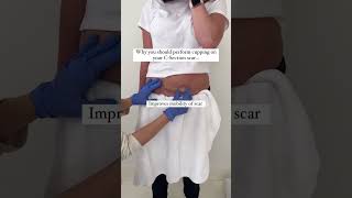 Why You Should Be Performing Cupping Your Csection Scarshorts csectionrecovery