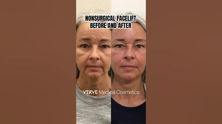 I Tried a Non-Surgical Facelift To See If It’s Worth The Hype