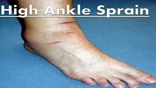 High Ankle Sprains - *The Complete Treatment Guide* screenshot 3