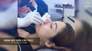 Cách tháo nẹp sau nâng mũi, nâng mũi bao lâu thì tháo nẹp?