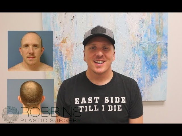OTOPLASTY - 1 Week Post Op patient reviews " Best of Nashville" Plastic Surgeon Dr. Chad Robbins
