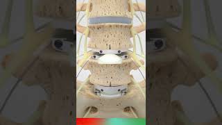 Spine Total Disc Replacement