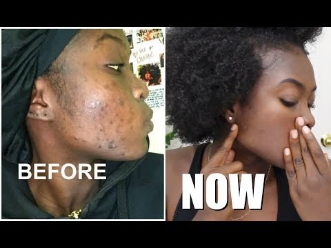 SKIN CARE UPDATE || CLEARING DARK MARKS & HYPERPIGMENTATION