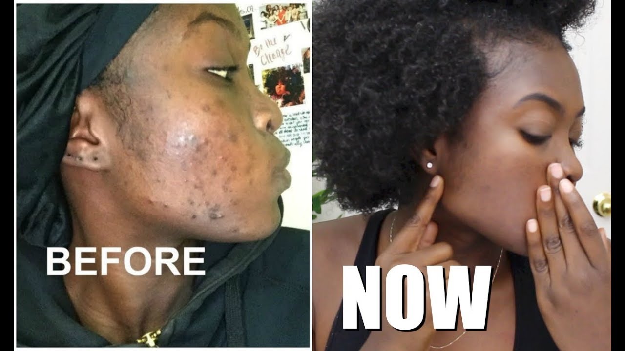 How to get rid of dark spots on black skin