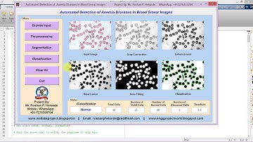 Anemia Detection in Blood Smear Images Using Image Processing Full Matlab Project