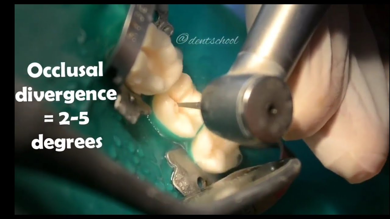 Class II Cast Metal Inlay Cavity Preparation Wax Pattern