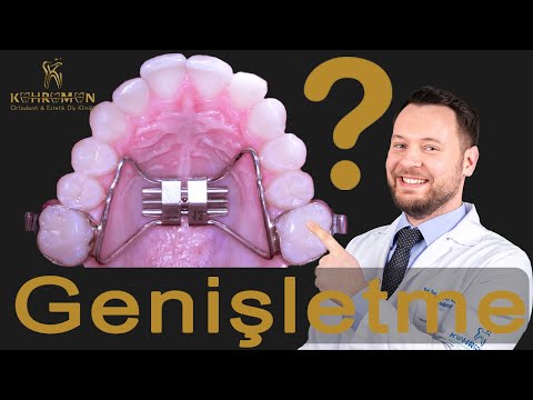 Hızlı Üst Çene Genişletmesi