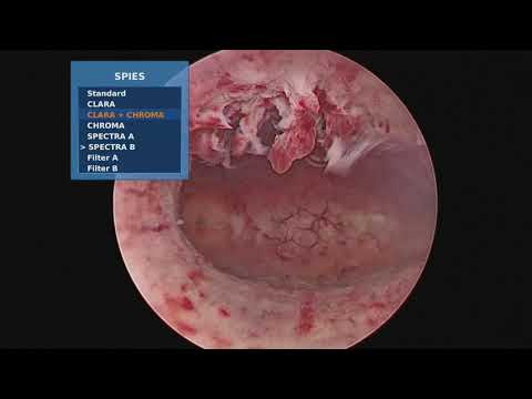 Video: Iperplasia Endometriale - Sintomi, Trattamento, Iperplasia Endometriale Ghiandolare