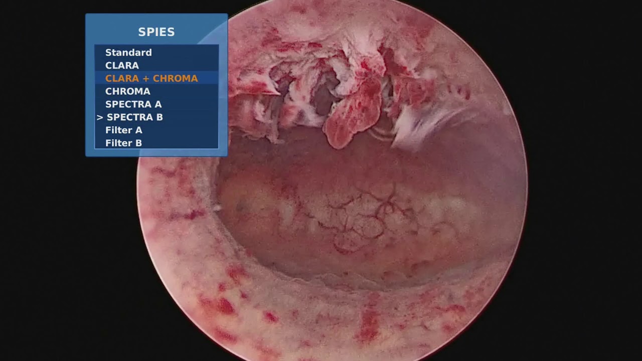 iperplasia by  by Eleonora Castellacci Ginecologia Isteroscopia