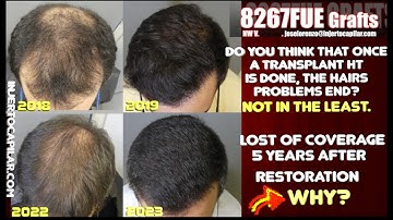 8267FUE Grafts. NW V. 2 step strategy w/4 mths gap. Lost of coverage 5 years later: WHY?. 2095/2018