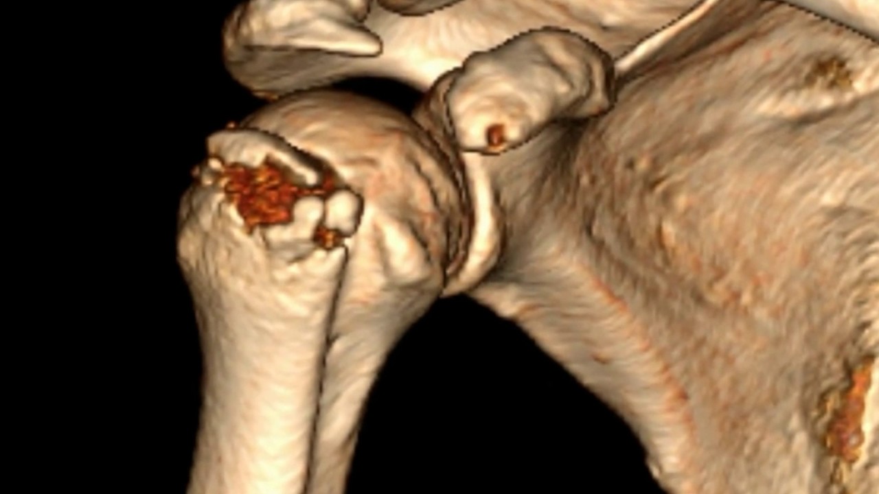 Greater Tuberosity Humerus Fracture Recovery Time