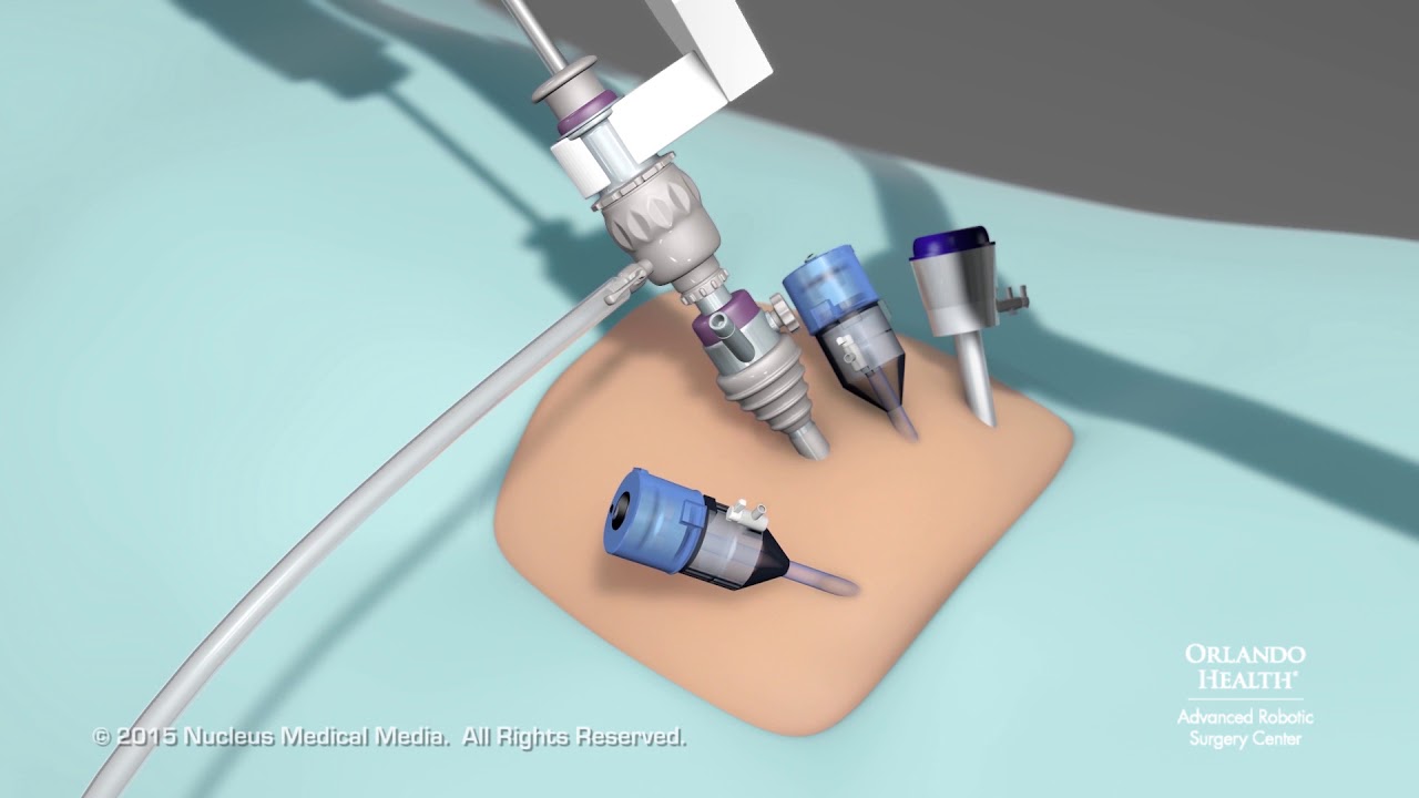 Orlando Health Advanced Robotic Surgery Center Robotic Hysterectomy