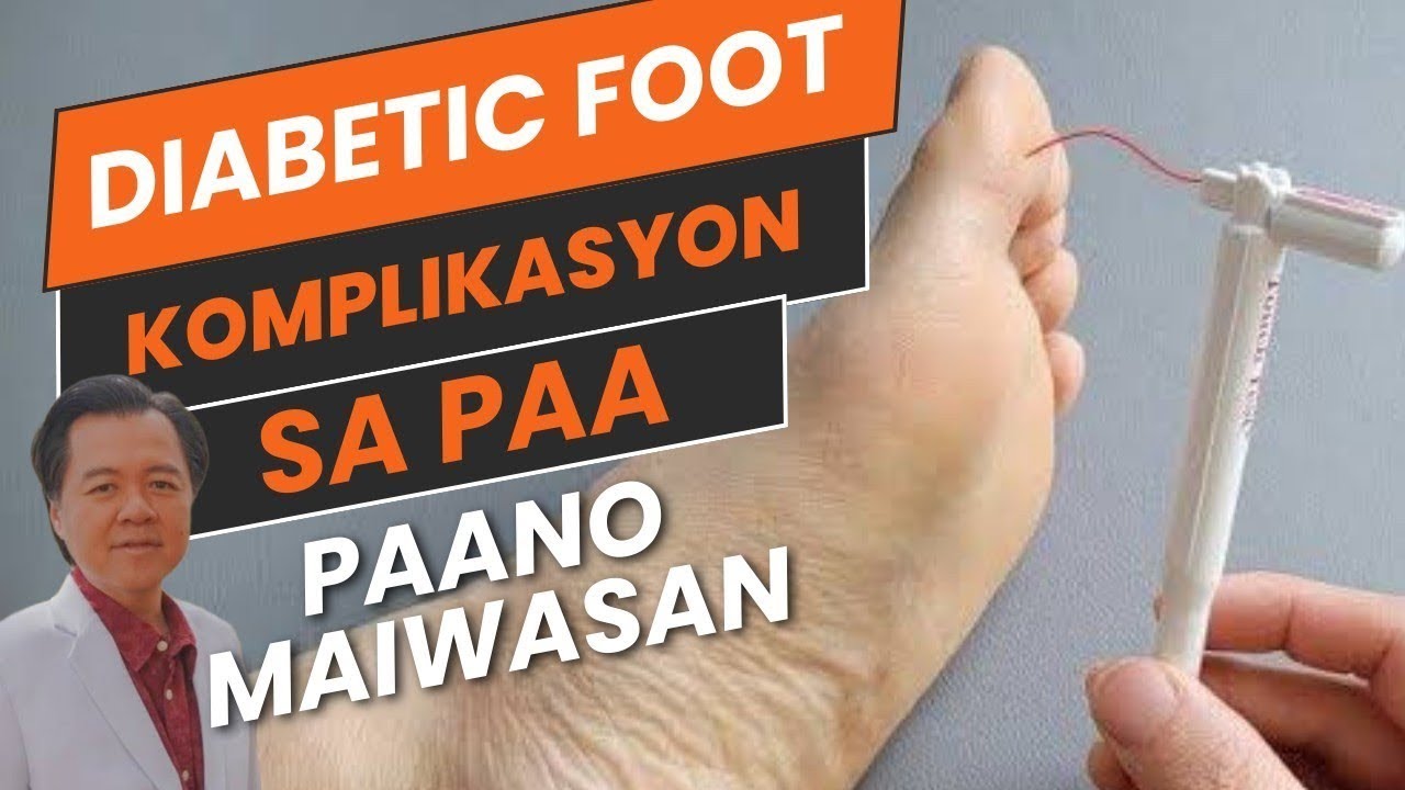 Diabetic Foot: Komplikasyon sa Paa Paano Maiwasan - By Doc Willie Ong