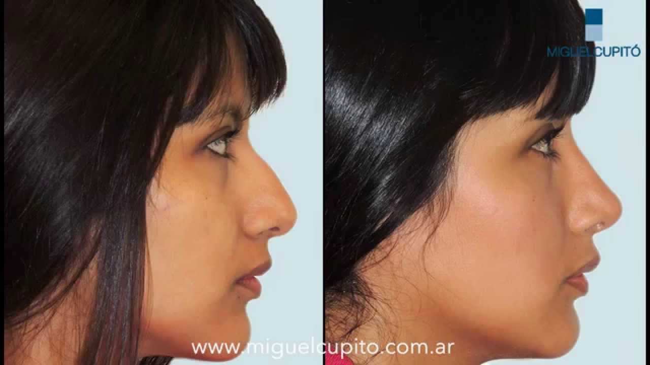 Fotos del antes y despues de una cirugia de nariz 70 Fotos del antes y despues de una cirugia de nariz 88