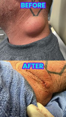 California Cyst Before and After