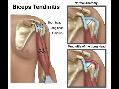 Video: Waar is schouder tendinitis?