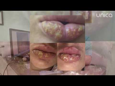 Video: Umflarea După Mărirea Buzelor Cu Acid Hialuronic: Cât Durează și Cum Să O Eliminați