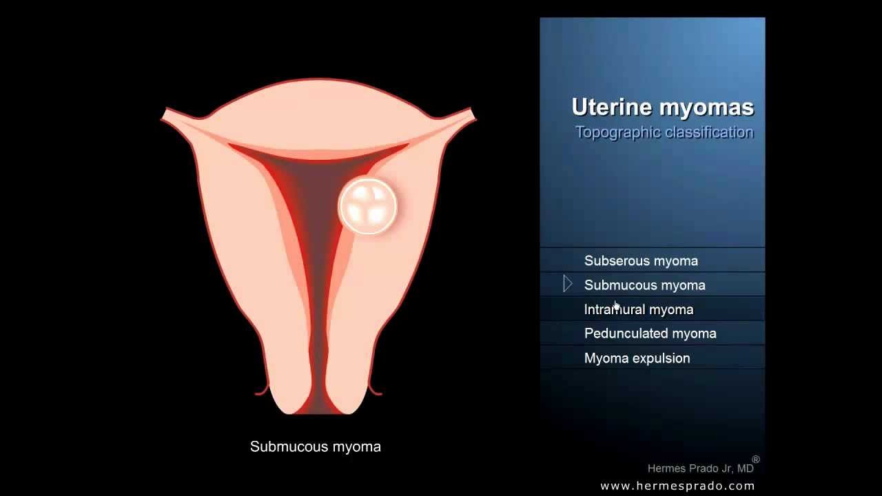Uterine Fibroids Or Myomas - Definition And Symptoms - Youtube