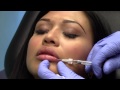 Subtle Natural Lip Enhancement with Restylane Chevy Chase Maryland