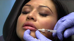 Subtle Natural Lip Enhancement with Restylane Chevy Chase Maryland