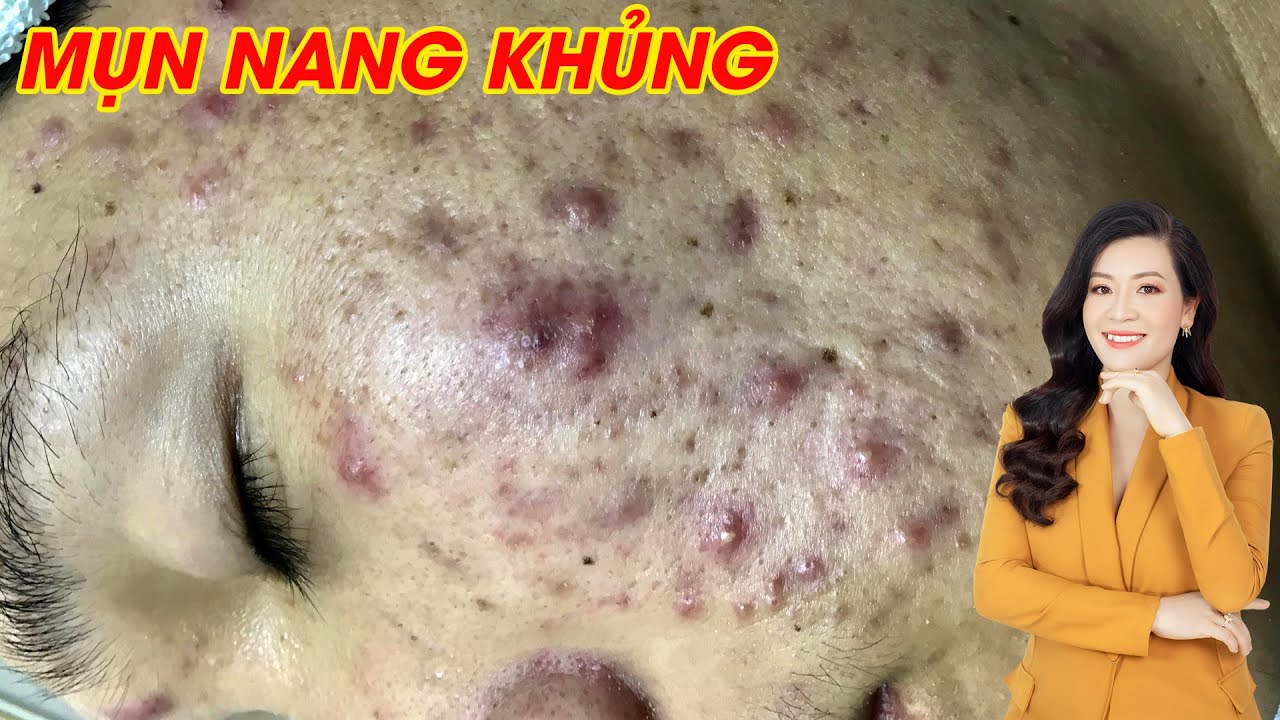 Lấy nhân mụn cam kết không gây thâm, sẹo tại HHV Clinic | Đỗ Thu Hiền | Hiền Vân Spa