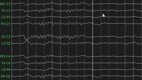 EEG Sleep Spindles and Vertex Waves 😴