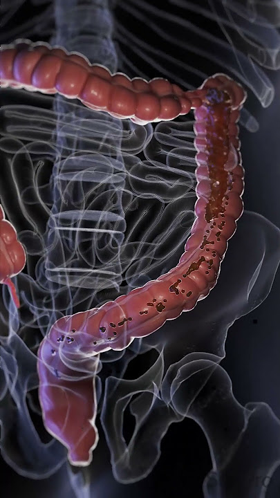Understanding Diarrhea: Causes, Symptoms, and Management  #anatomy #meded #3danimation