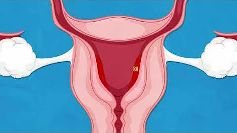 How does mifepristone work?