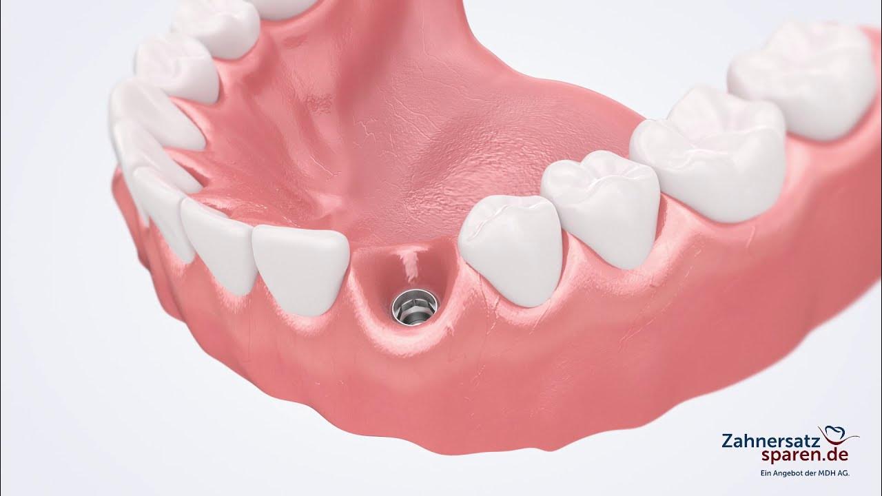 Behandlungsablauf Krone auf Implantat Zahnersatzsparen.de YouTube