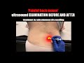 Back mice ultrasound examination before and after dry needling painful hard knot in lower back