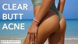 booty acne removal