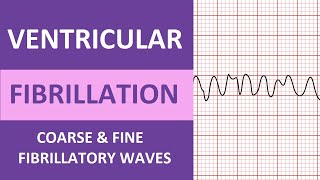 Ventricular Fibrillation (V-Fib) ECG Interpretation Nursing Heart Rhythms  NCLEX ACLS