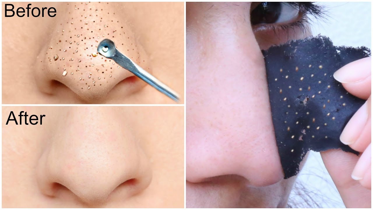 blackhead removal mask diy