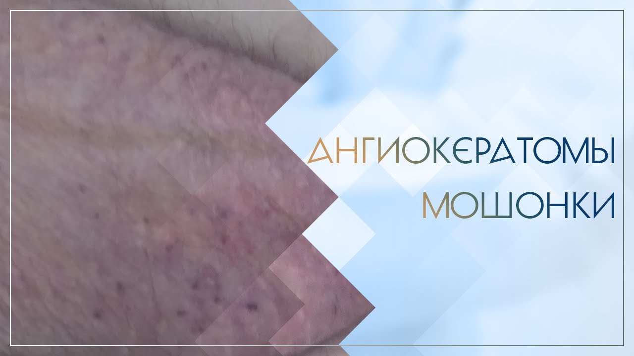 ☹ Ангиокератомы мошонки. Клинический случай №43
