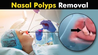 Nasal Polyps and their treatment  | How Polypectomy is Performed? (Urdu/Hindi) screenshot 3