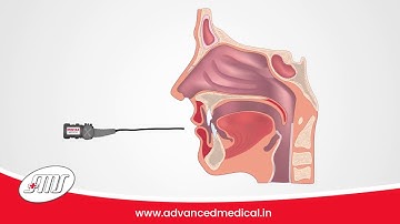 What is Flexible Endoscopy?