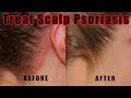 How to Treat Scalp Psoriasis – 5 Natural Ways for Treating Psoriasis of the Scalp at Home