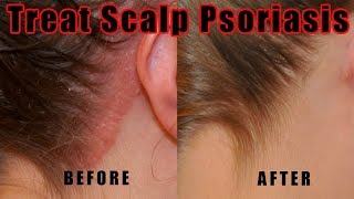 scalp psoriasis natural treatment reddit