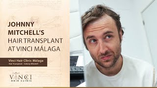 Transforming Locks and Laughter: Johnny Mitchell's Hair Transplant Journey at Vinci Malaga, Spain