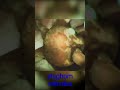 Staghorn calculus  kidney stone  huge stone with horns in kidney