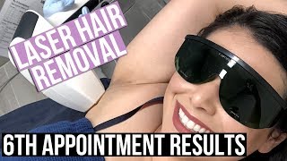 FINAL LASER HAIR REMOVAL RESULTS AFTER 6TH TREATMENT (Underarms & Bikini Line)