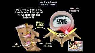 Low Back Pain & Disc Herniation  Everything You Need To Know  Dr. Nabil Ebraheim